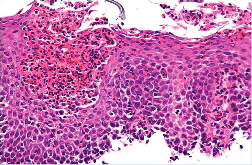 Histological Response Graphic