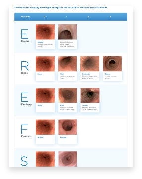 Endoscopic Reference Score (EREFS)